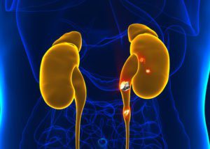 Kidney disease