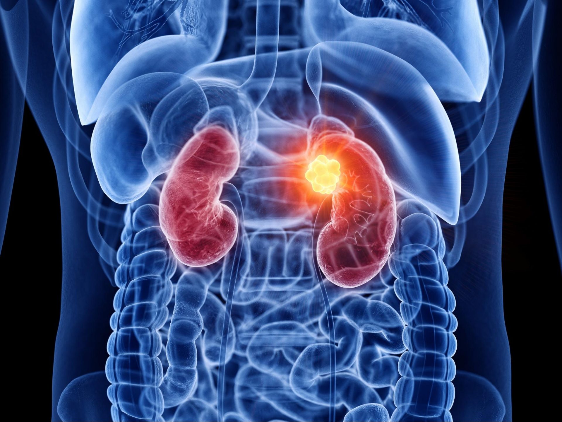 The Effects CKD Can Have on the Rest of Your Body - Durham Nephrology ...