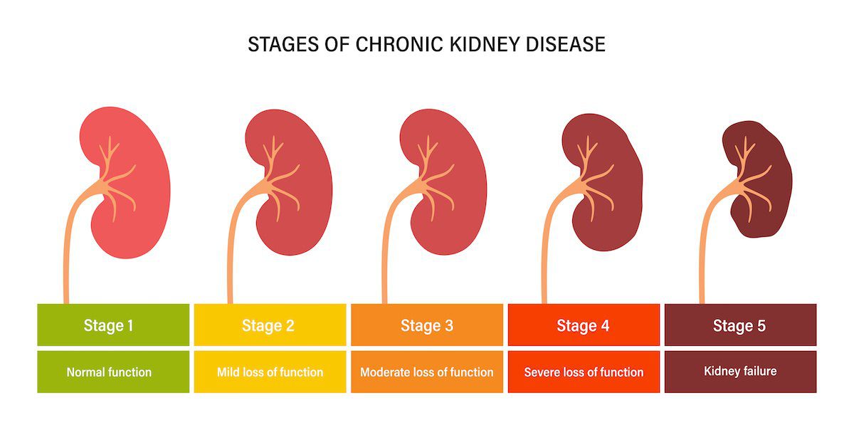 Understanding The 5 Stages Of Kidney Disease Durham Nephrology